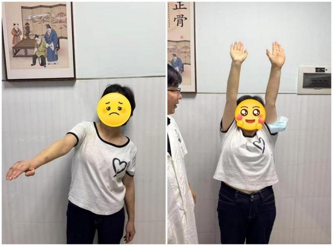 右肩痛得动弹不得梳头都受限！医生用这套方法化解她1年肩僵痛